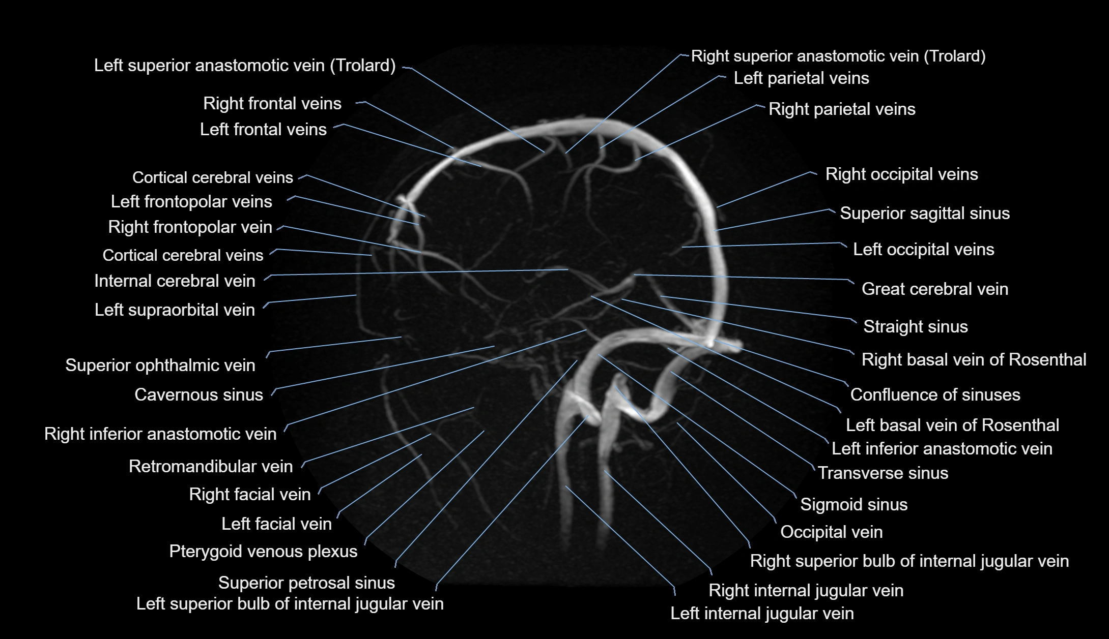 MRV brain MIP sagittal labelled anatomy 3T MRI images -img-1011001-00007.webp
